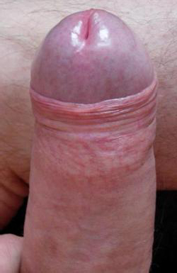 Foreskin tightening